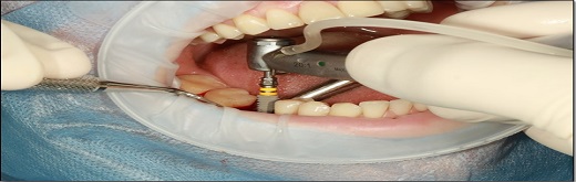 Dental Biomaterial Market Trend - Ensuring Efficacious Oral Care