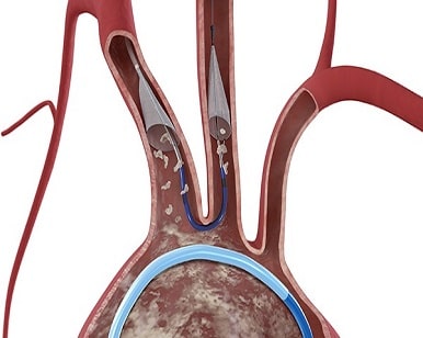 Importance of Embolic Protection Devices in Preventing Surgical Complications